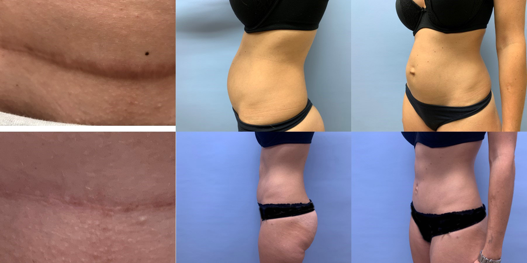 Tummy Tuck Patient 49 | Scottsdale Plastic Surgeon, Dr. Shaun Parson