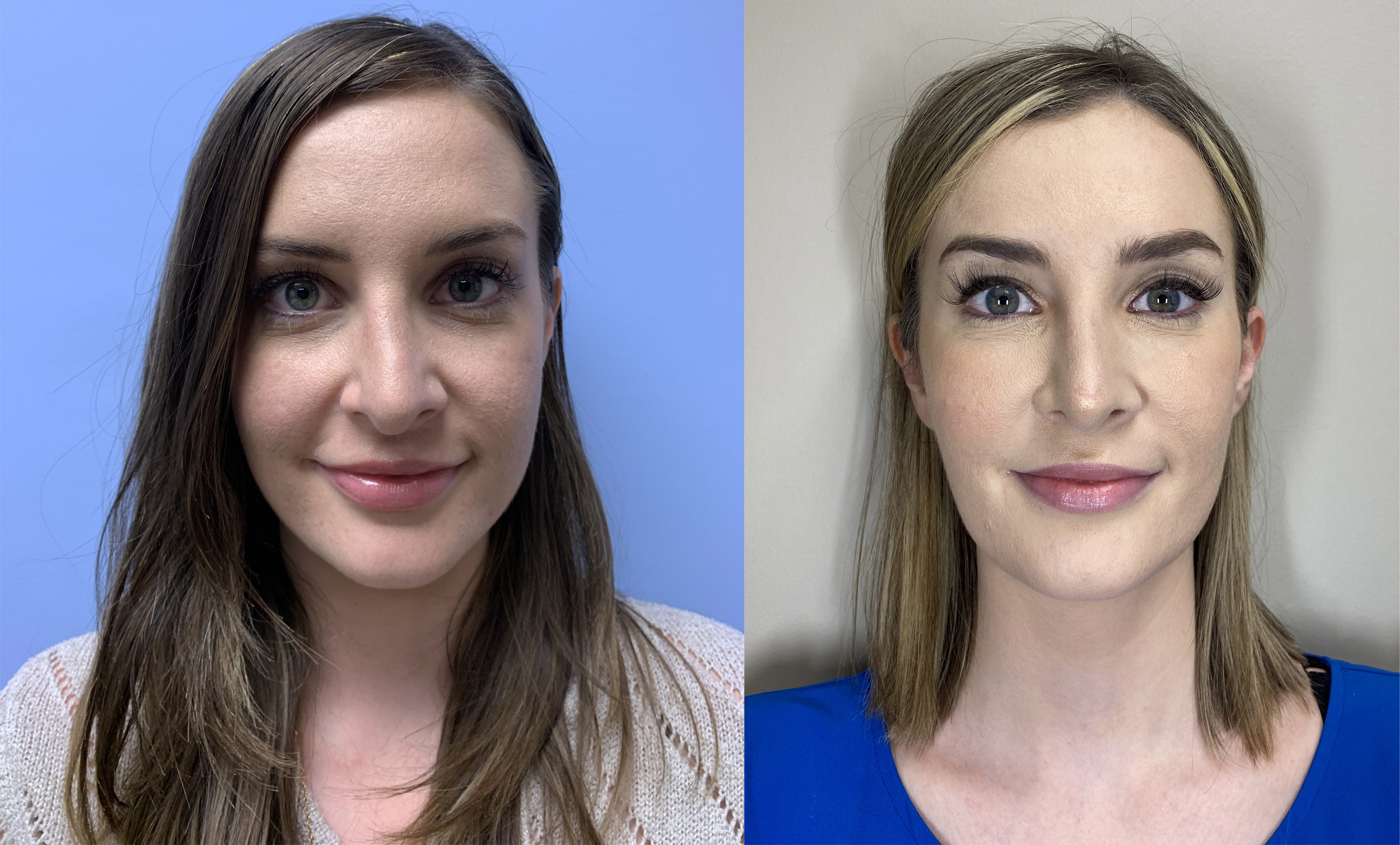 Rhinoplasty Patient 13 | Dr. Shaun Parson, Scottsdale, AZ