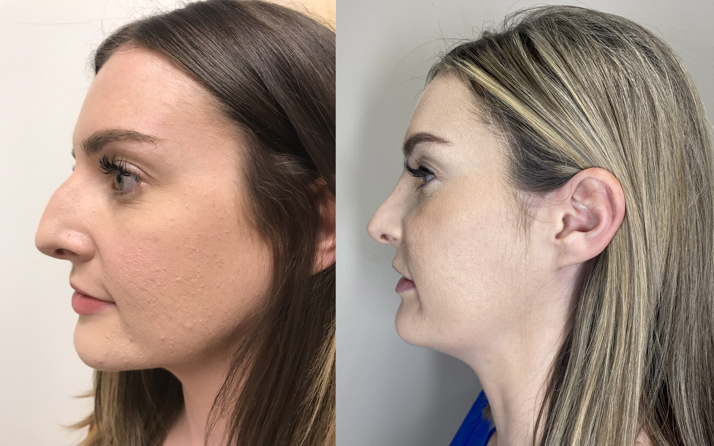 Rhinoplasty Patient 13 | Dr. Shaun Parson, Scottsdale, AZ