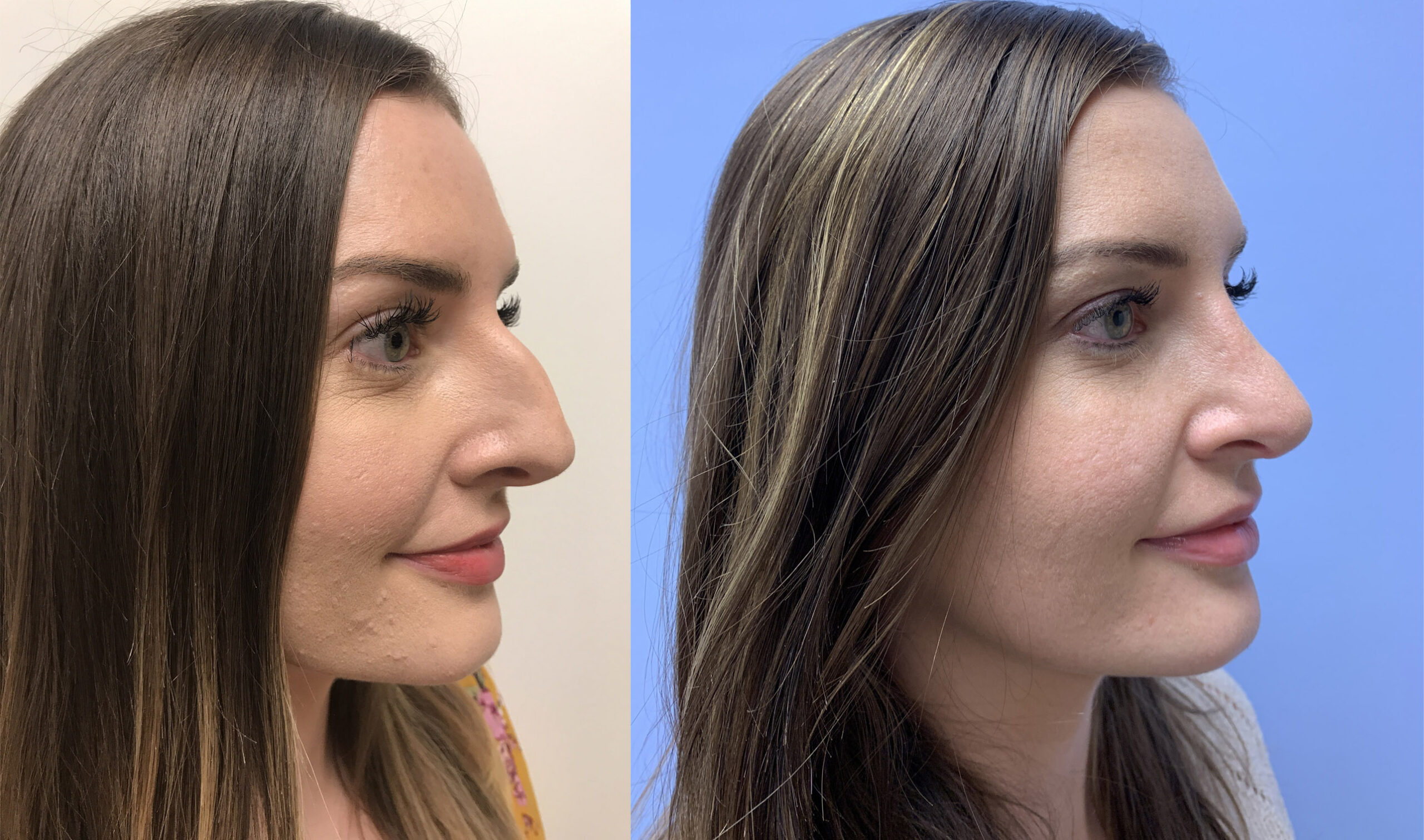 Rhinoplasty Patient 13 | Dr. Shaun Parson, Scottsdale, AZ