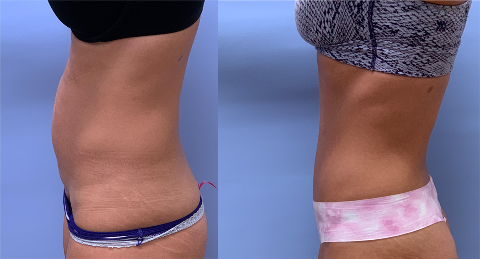 Tummy Tuck Patient 48 | Scottsdale, Dr. Shaun Parson