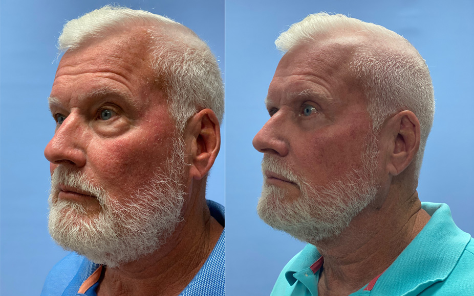 Eyelid Patient 36 | Dr. Shaun Parson, Scottsdale AZ