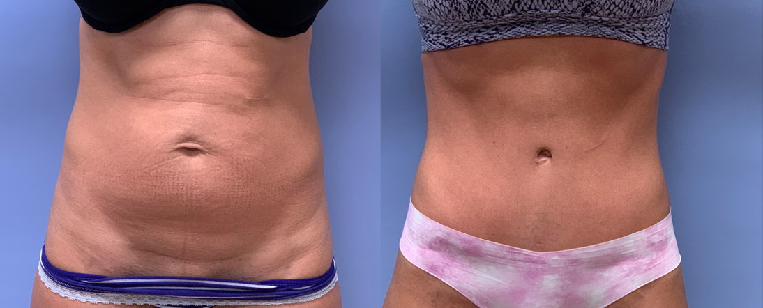 Tummy Tuck Patient 48 | Scottsdale, Dr. Shaun Parson