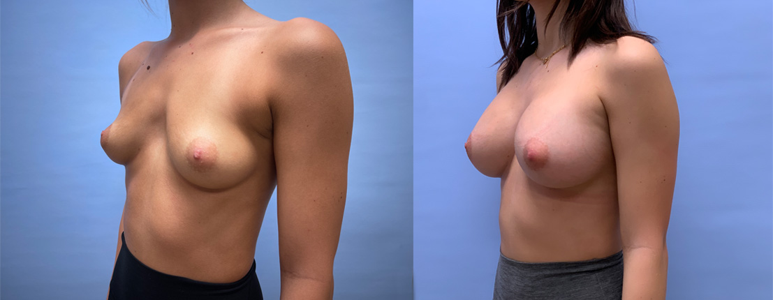 Breast Augmentation Patient 58 | Dr. Shaun Parson, Scottsdale, AZ