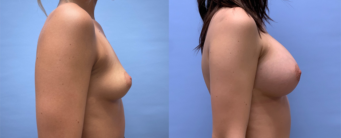 Breast Augmentation Patient 58 | Dr. Shaun Parson, Scottsdale, AZ