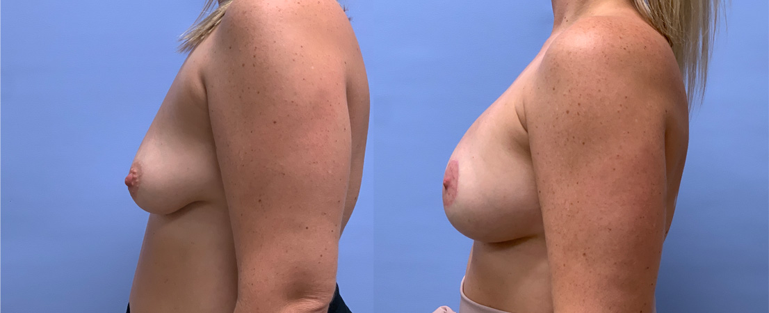 Breast Lift with Peri-Areolar Augmentation Patient 37 | Dr. Shaun Parson