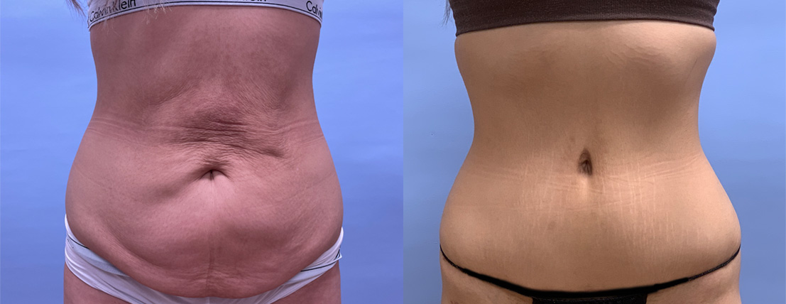 Tummy Tuck Patient 49 | Scottsdale Plastic Surgeon, Dr. Parson