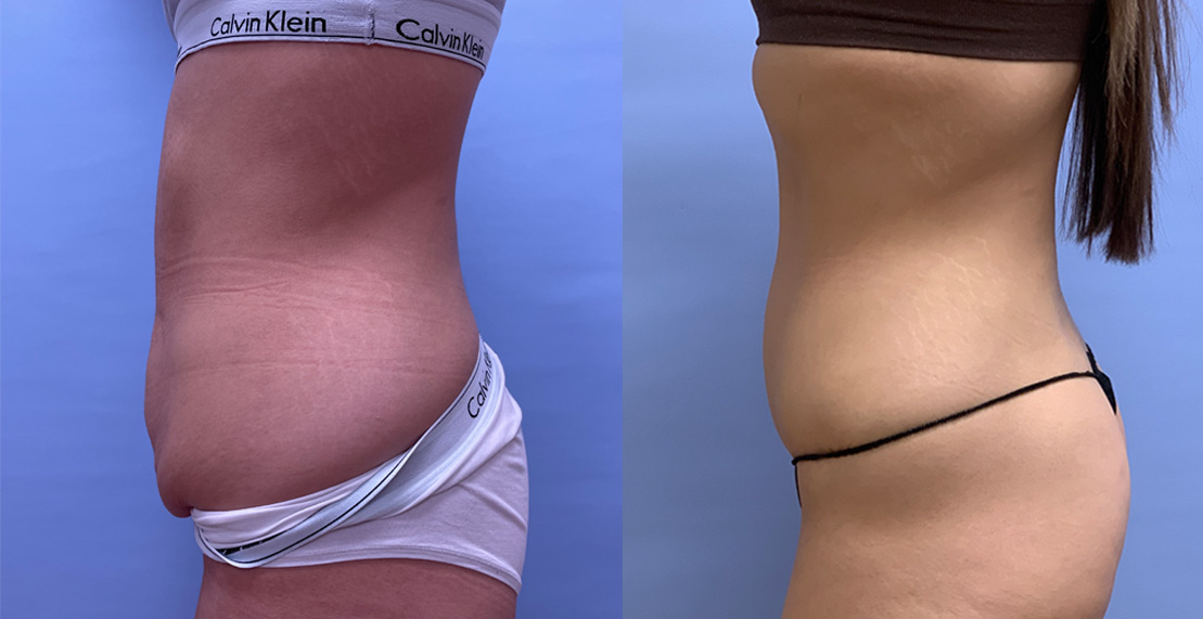 Tummy Tuck Patient 49 | Scottsdale Plastic Surgeon, Dr. Parson