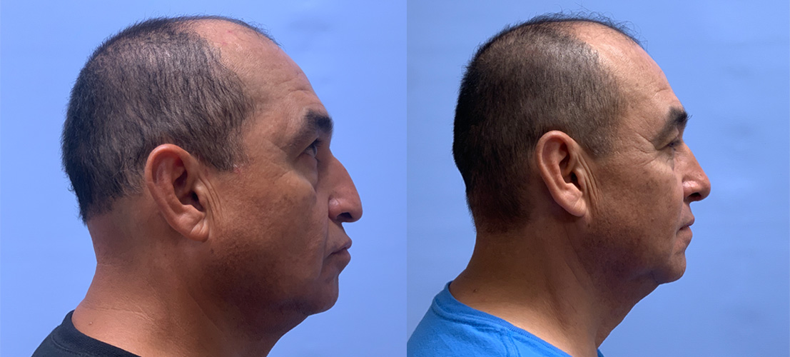 Rhinoplasty Patient 14 | Dr. Shaun Parson, Scottsdale, AZ