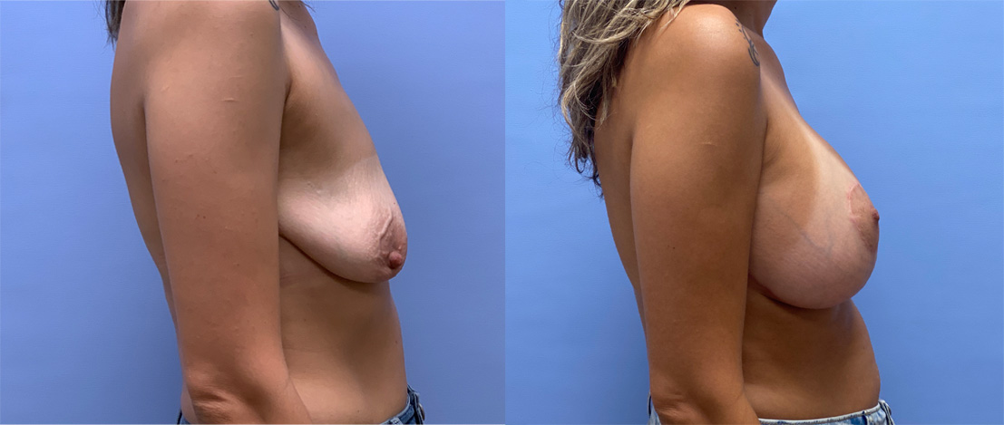 Breast Lift with Augmentation Patient 25 | Dr. Shaun Parson Plastic Surgery