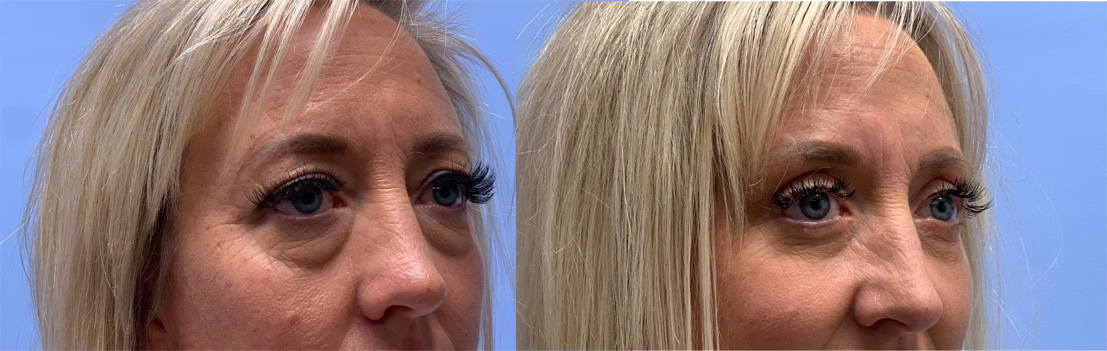 Eyelid Patient 37 | Dr. Shaun Parson, Scottsdale AZ