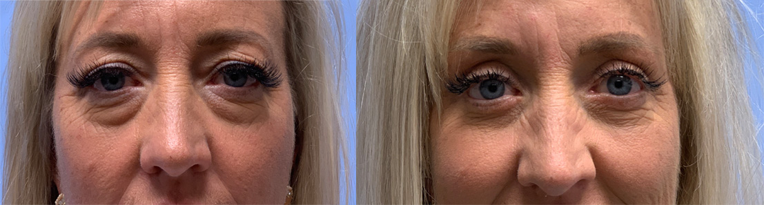 Eyelid Patient 37 | Dr. Shaun Parson, Scottsdale AZ