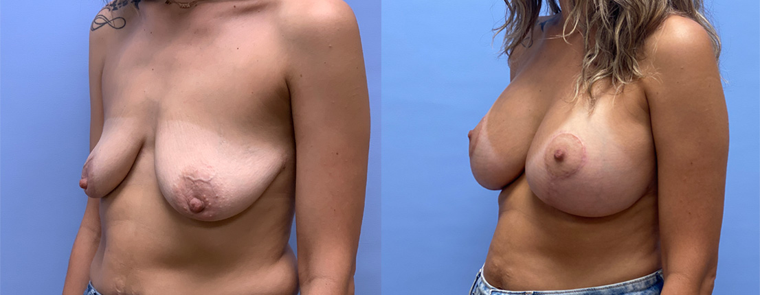 Breast Lift with Augmentation Patient 25 | Dr. Shaun Parson Plastic Surgery