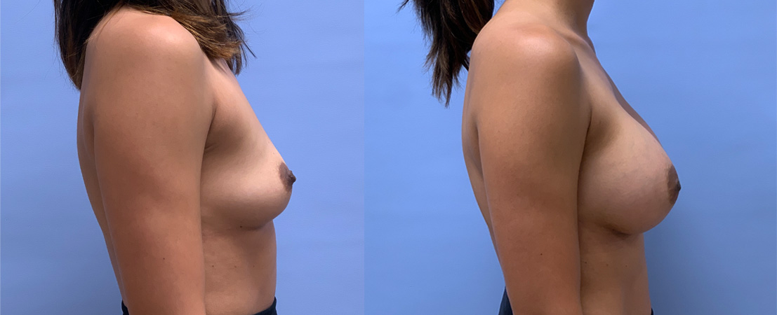 Breast Augmentation Patient 59 | Dr. Shaun Parson, Scottsdale, AZ