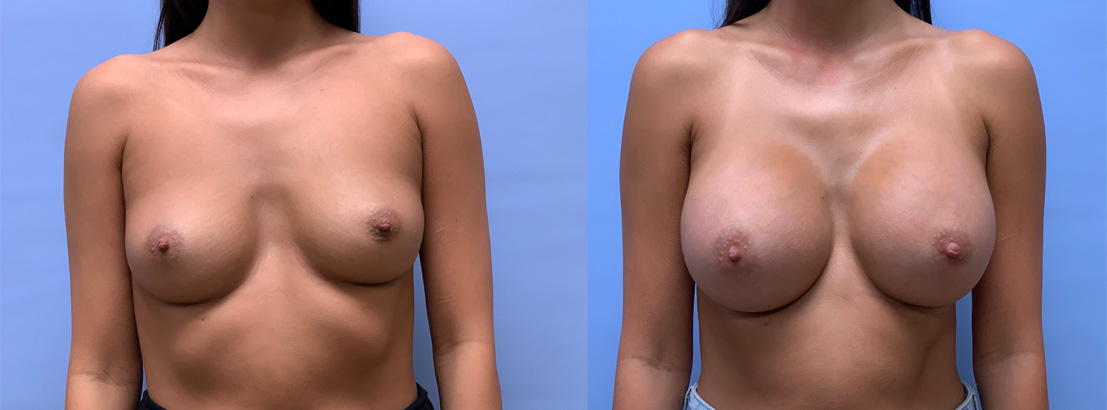 Breast Augmentation Patient 60 | Dr. Shaun Parson, Scottsdale, AZ