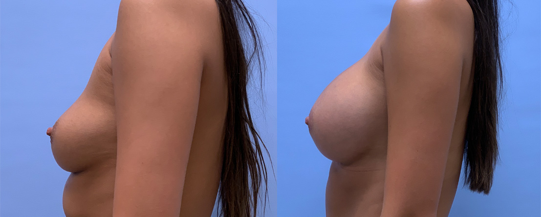 Breast Augmentation Patient 60 | Dr. Shaun Parson, Scottsdale, AZ