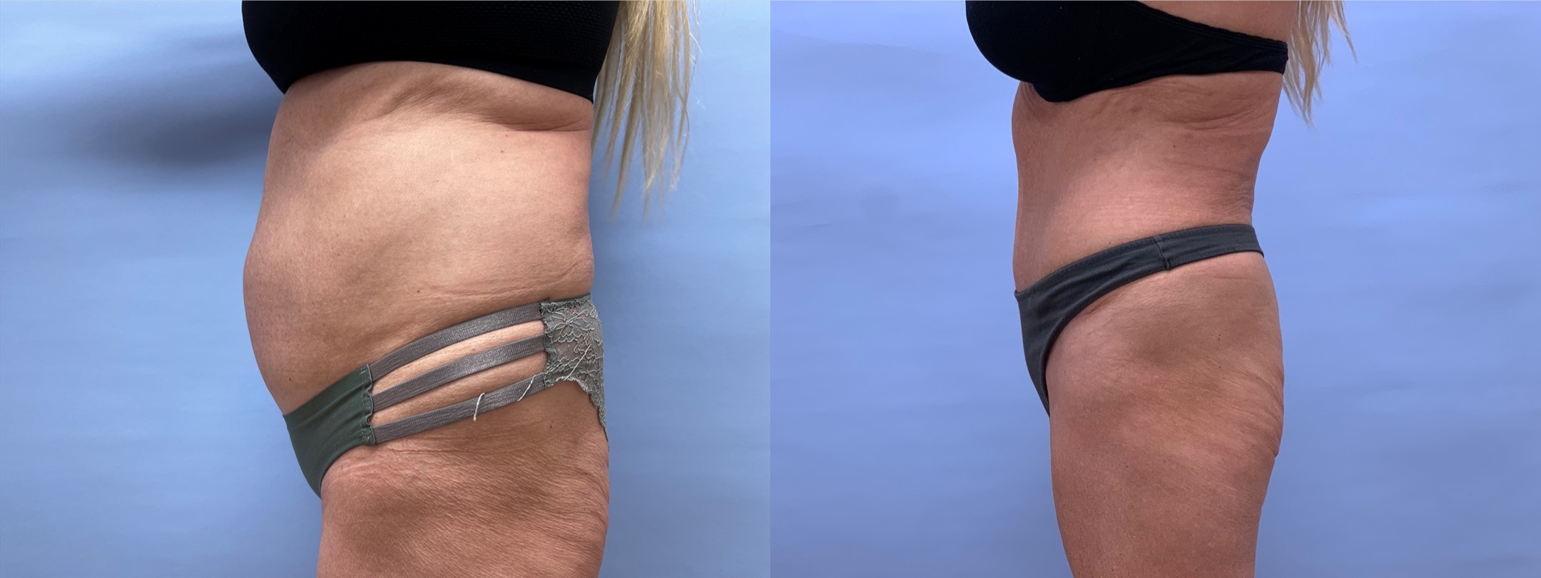 Tummy Tuck Patient 50 | Dr. Shaun Parson, Scottsdale AZ