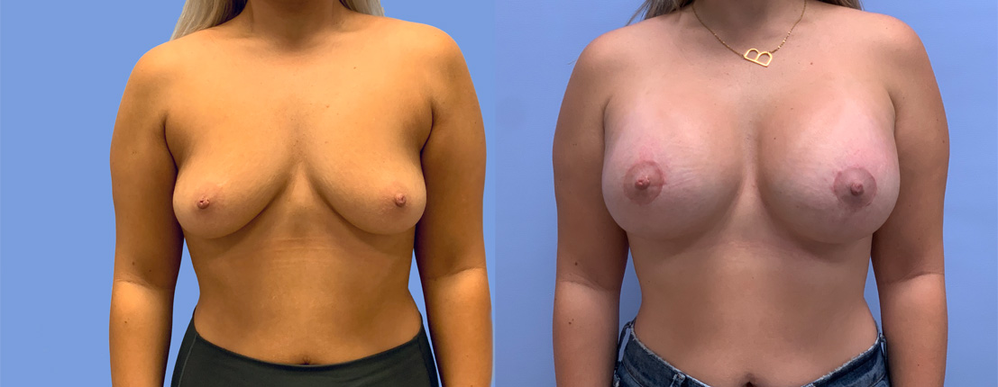 Peri-Areolar Breast Lift with Augmentation Patient 37 | Dr. Shaun Parson, Scottsdale, AZ