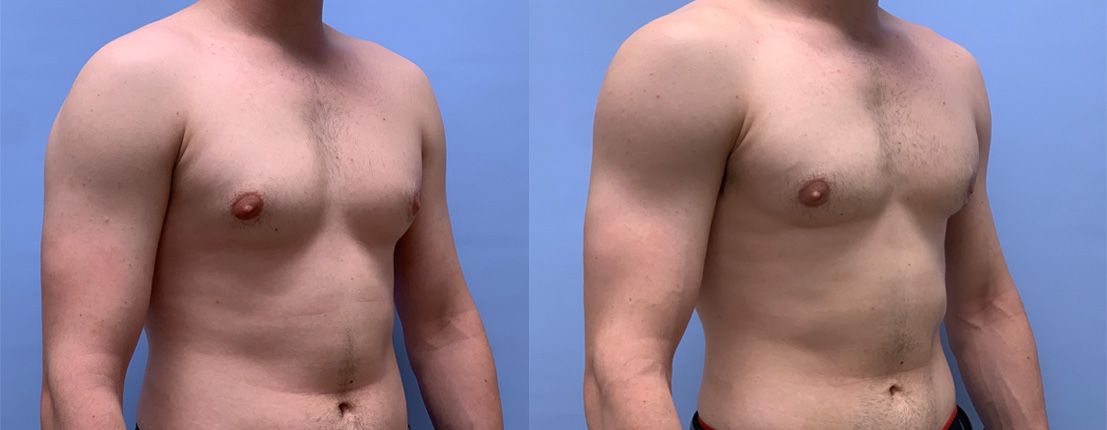 Gynecomastia Patient 20 | Dr. Shaun Parson Plastic Surgery & Skin Center