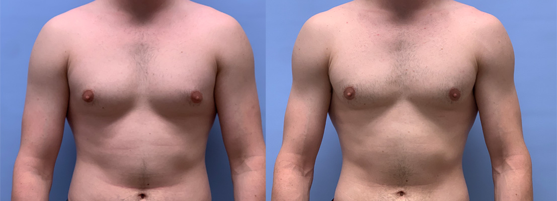 Gynecomastia Patient 20 | Dr. Shaun Parson Plastic Surgery & Skin Center