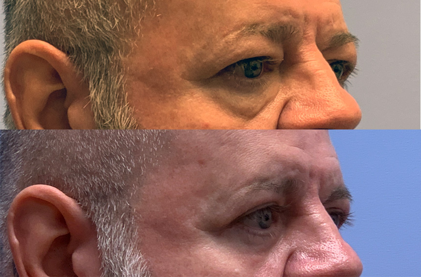 Eyelid Patient 39 | Dr. Shaun Parson, Scottsdale AZ