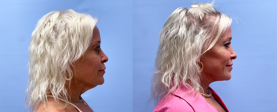 Lower facelift/necklift Patient 27 | Dr. Shaun Parson