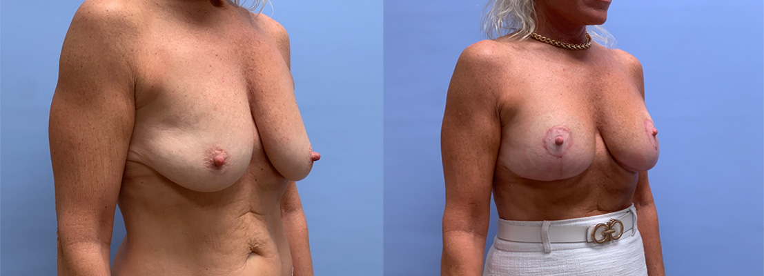 Breast Lift with Augmentation Patient 27 | Dr. Shaun Parson Plastic Surgery