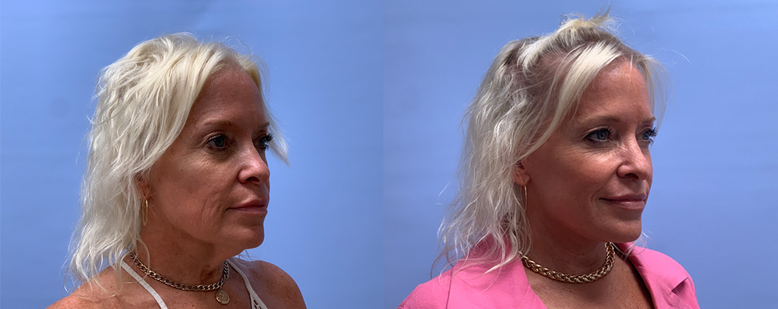 Lower facelift/necklift Patient 27