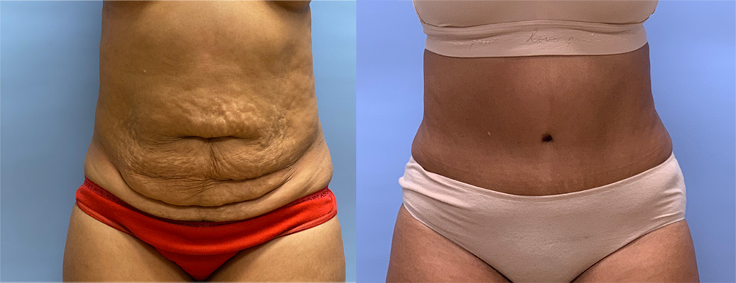 Tummy Tuck Patient 51 | Dr. Shaun Parson Plastic Surgery, Scottsdale, AZ