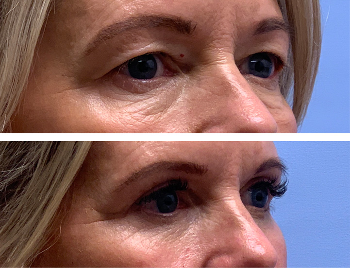 Eyelid Patient 50 | Dr. Shaun Parson Plastic Surgery, Scottsdale, AZ