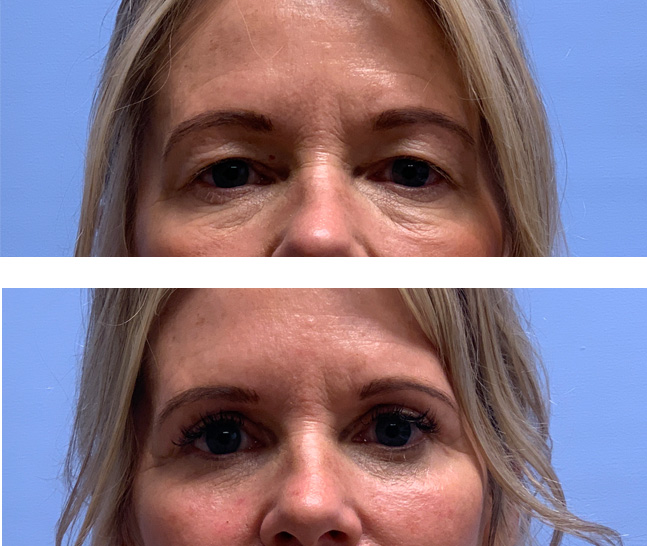 Eyelid Patient 50 | Dr. Shaun Parson Plastic Surgery, Scottsdale, AZ