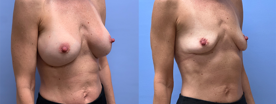 Breast Explant Patient 19 | Dr. Shaun Parson Plastic Surgery