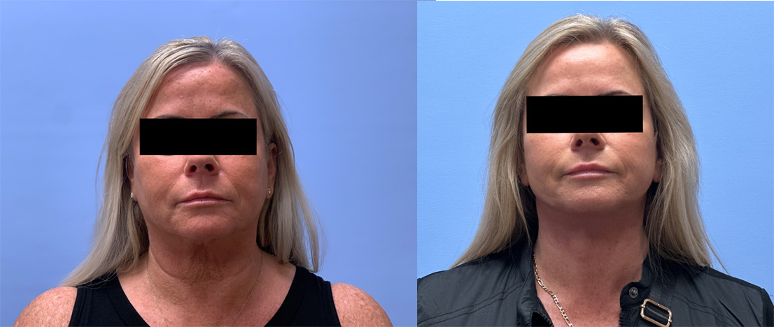 Lower Face and Neck Lift Patient #28 | Dr. Shaun Parson Plastic Surgery