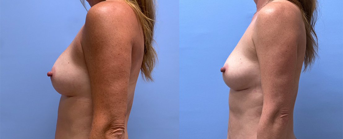 Breast Explant 21 | Dr. Shaun Parson Plastic Surgery, Scotts