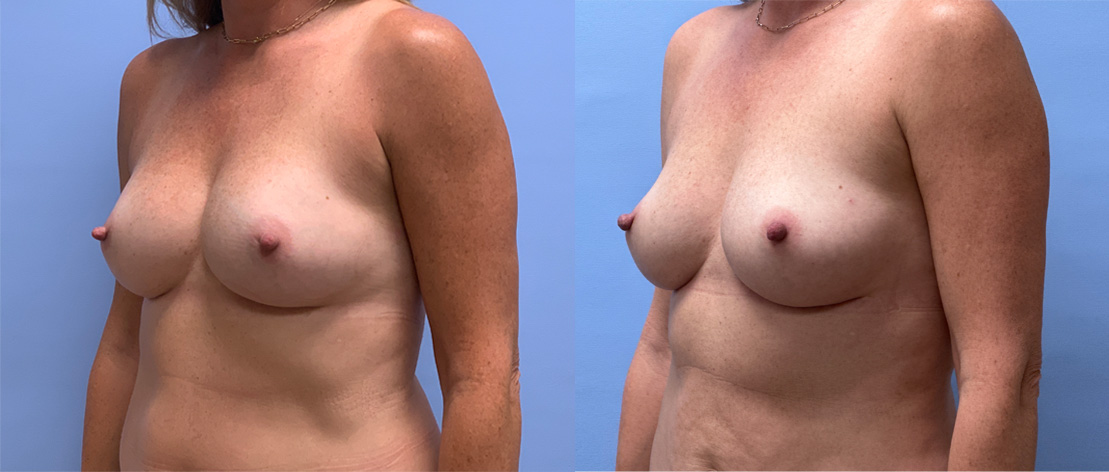 Breast Explant 21 | Dr. Shaun Parson Plastic Surgery, Scotts