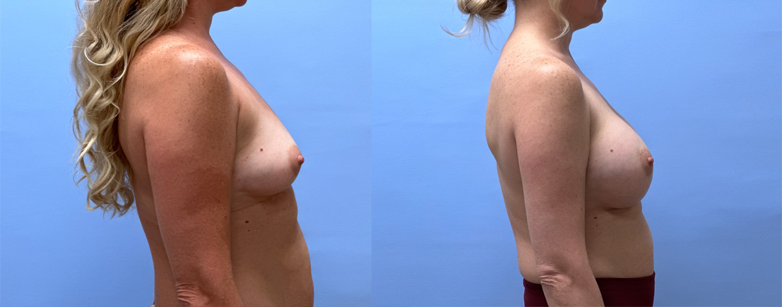 Breast Augmentation Patient 60 | Dr. Shaun Parson Plastic Surgery