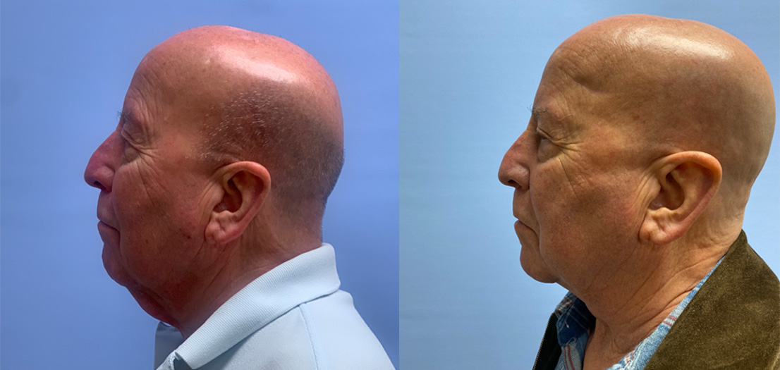 Neck Lift Patient 30 | Dr. Shaun Parson Plastic Surgery