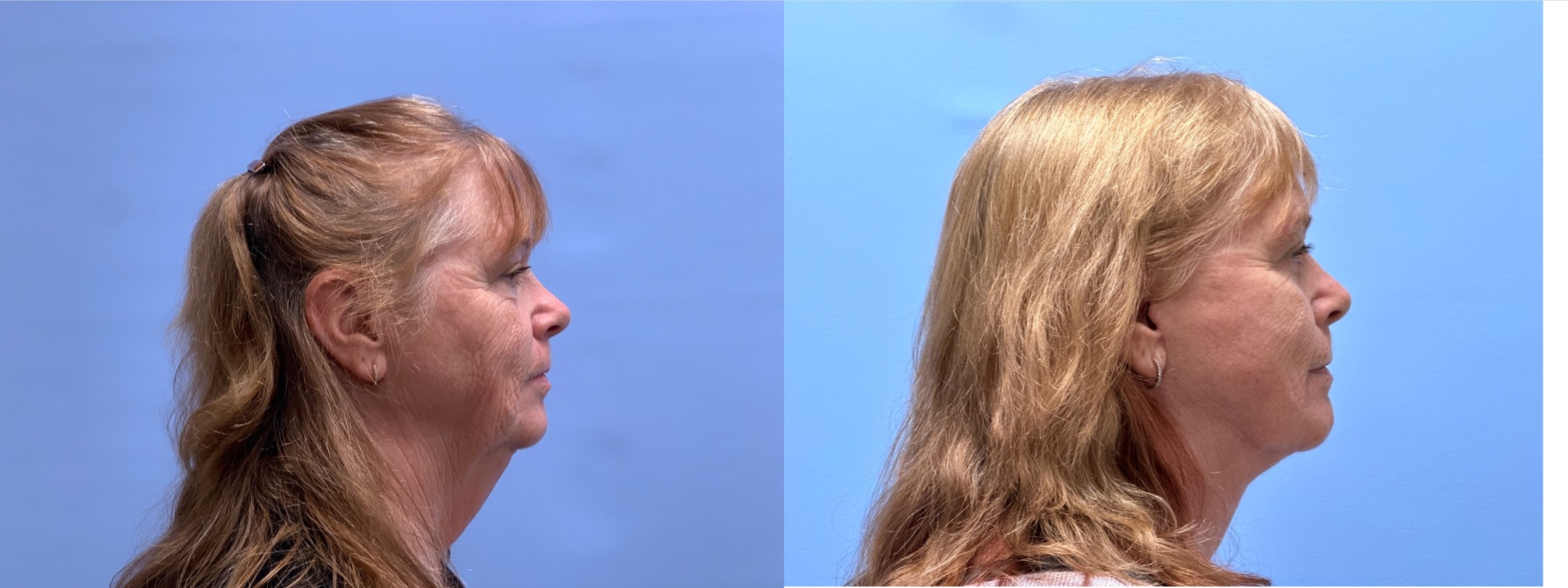 Lower Facelift 31 | Dr. Shaun Parson Plastic Surgery, Scottsdale