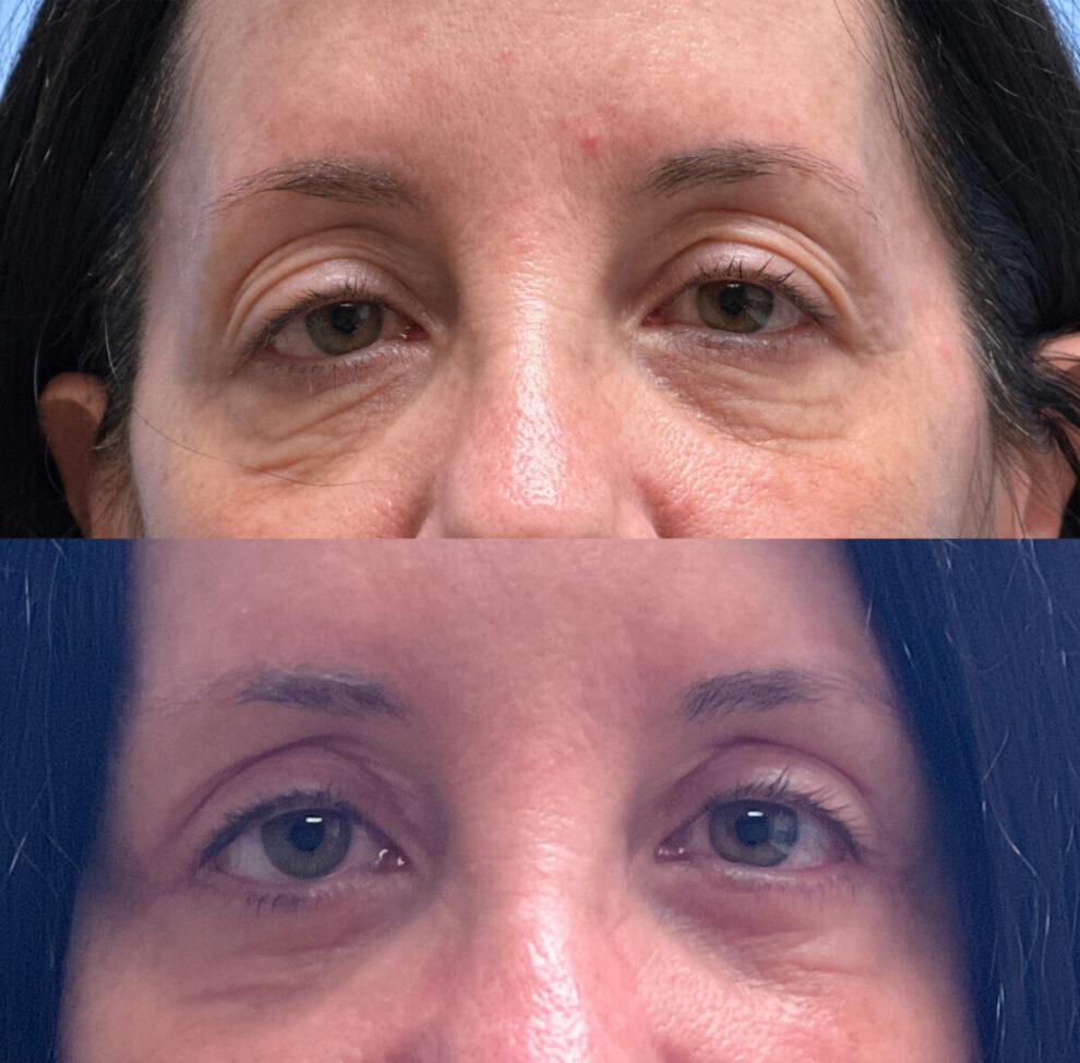 Eyelid Patient 44 | Dr. Shaun Parson Plastic Surgery, Scottsdale