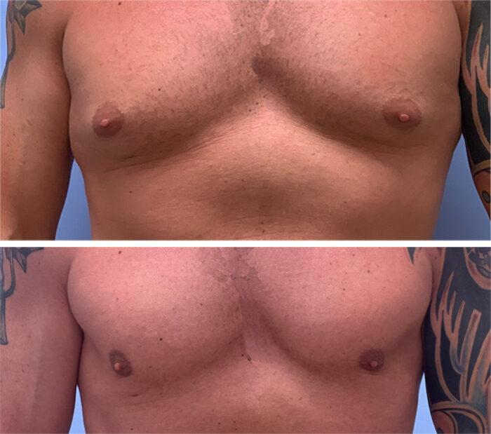 Gynecomastia Patient 21 | Dr. Shaun Parson Plastic Surgery, Scottsdale