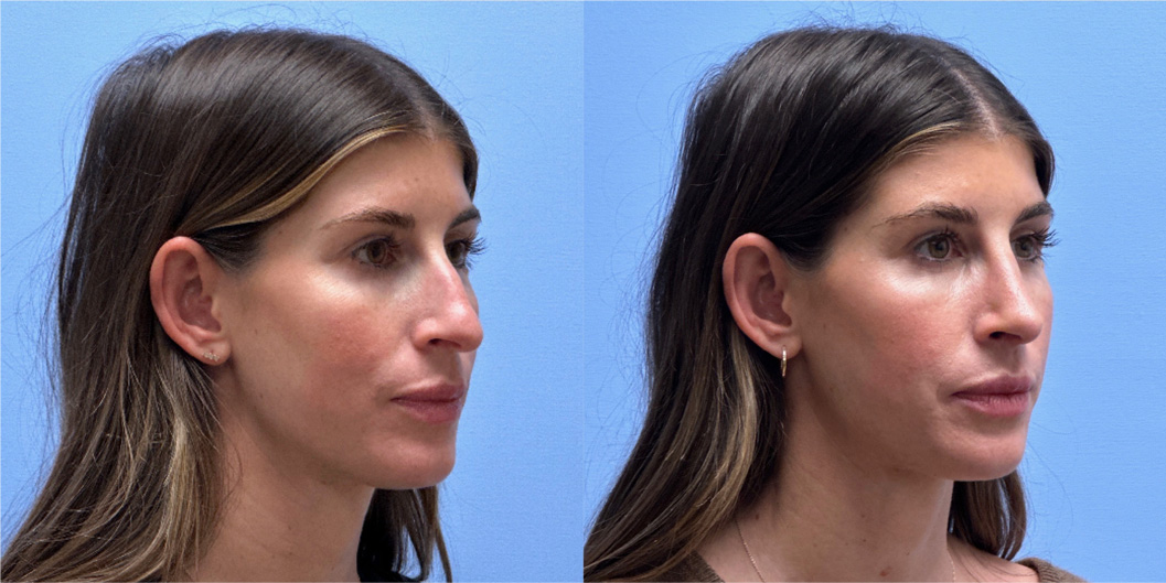 Rhinoplasty Patient 16 | Dr. Shaun Parson, Scottsdale