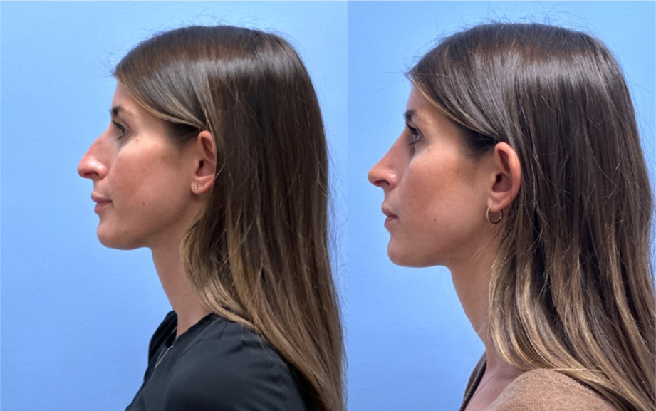 Rhinoplasty Patient 11 | Dr. Shaun Parson, Scottsdale