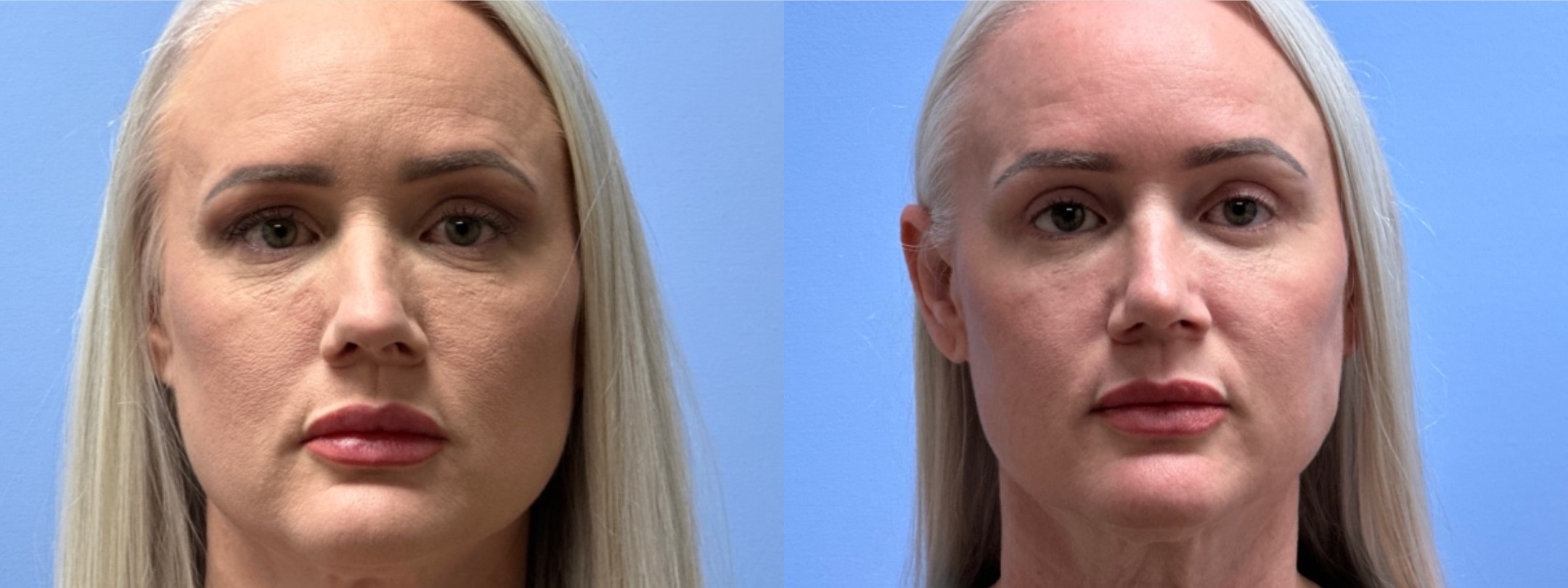 Rhinoplasty + Eyelid Surgery | Dr. Shaun Parson Plastic Surgery, Scottsdale