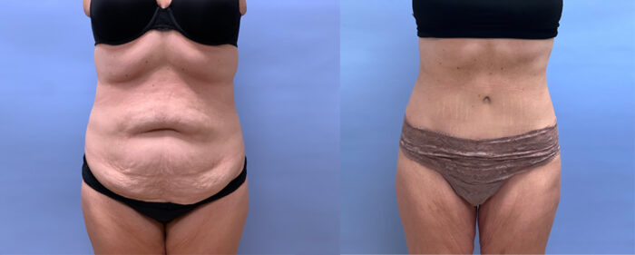 Tummy Tuck Patient 53 | Dr. Shaun Parson Plastic Surgery