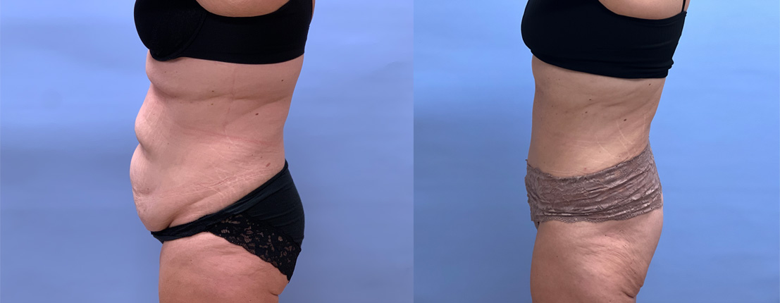 Tummy Tuck Patient 53 | Dr. Shaun Parson Plastic Surgery