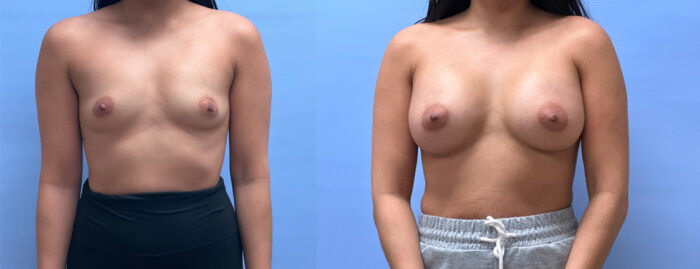 Breast Augmentation Patient 62 | Dr. Shaun Parson Plastic Surgery