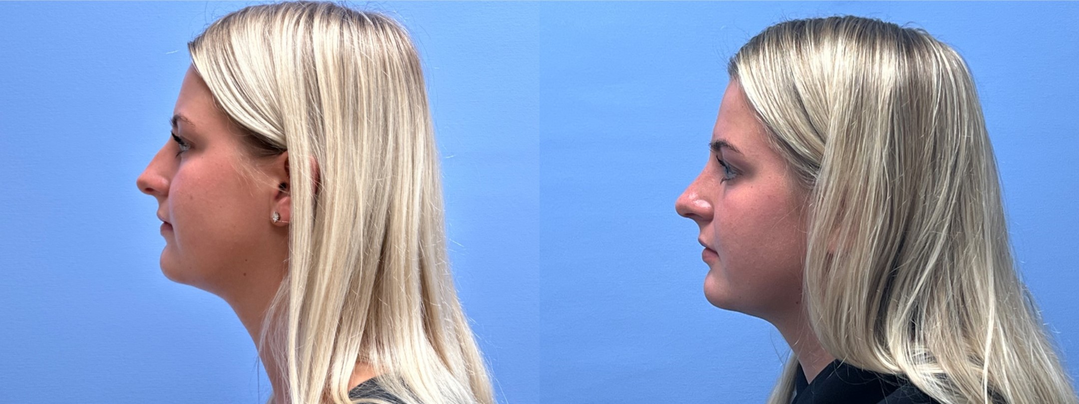 Rhinoplasty Patient 18 | Dr. Shaun Parson Plastic Surgery & Skin Center