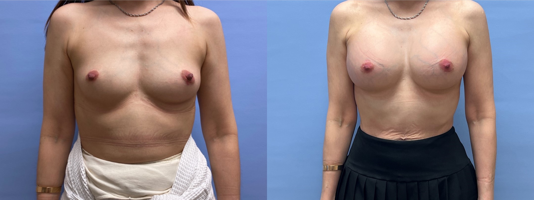 Breast Augmentation Patient 63 | Dr. Shaun Parson Plastic Surgery