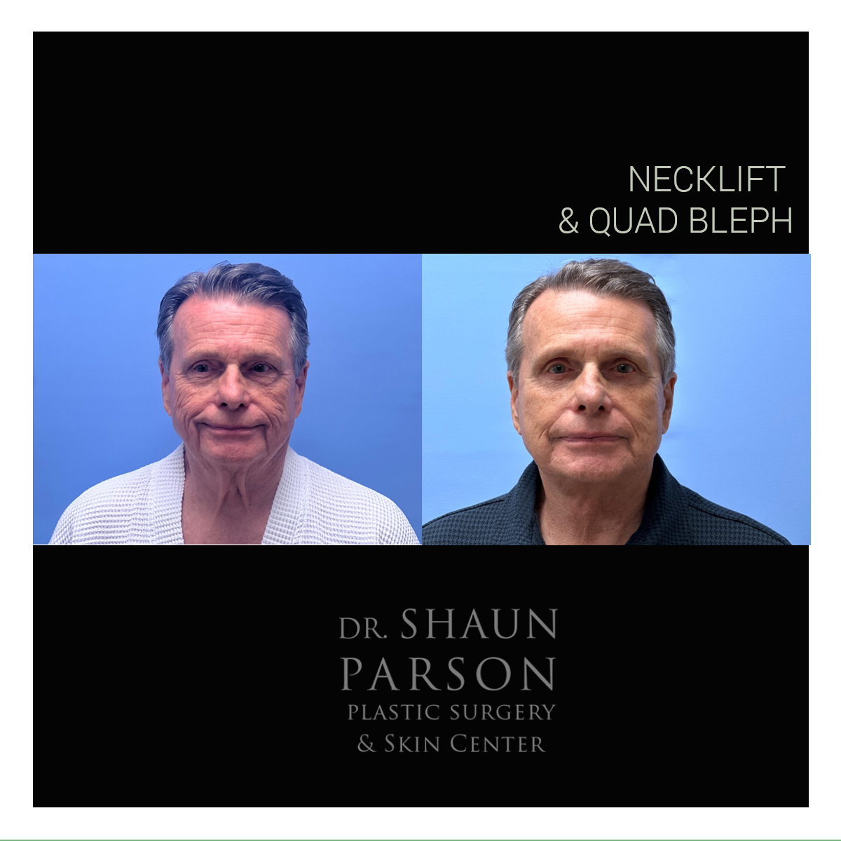 Necklift + Quad Bleph Patient 34 | Dr. Parson Scottsdale