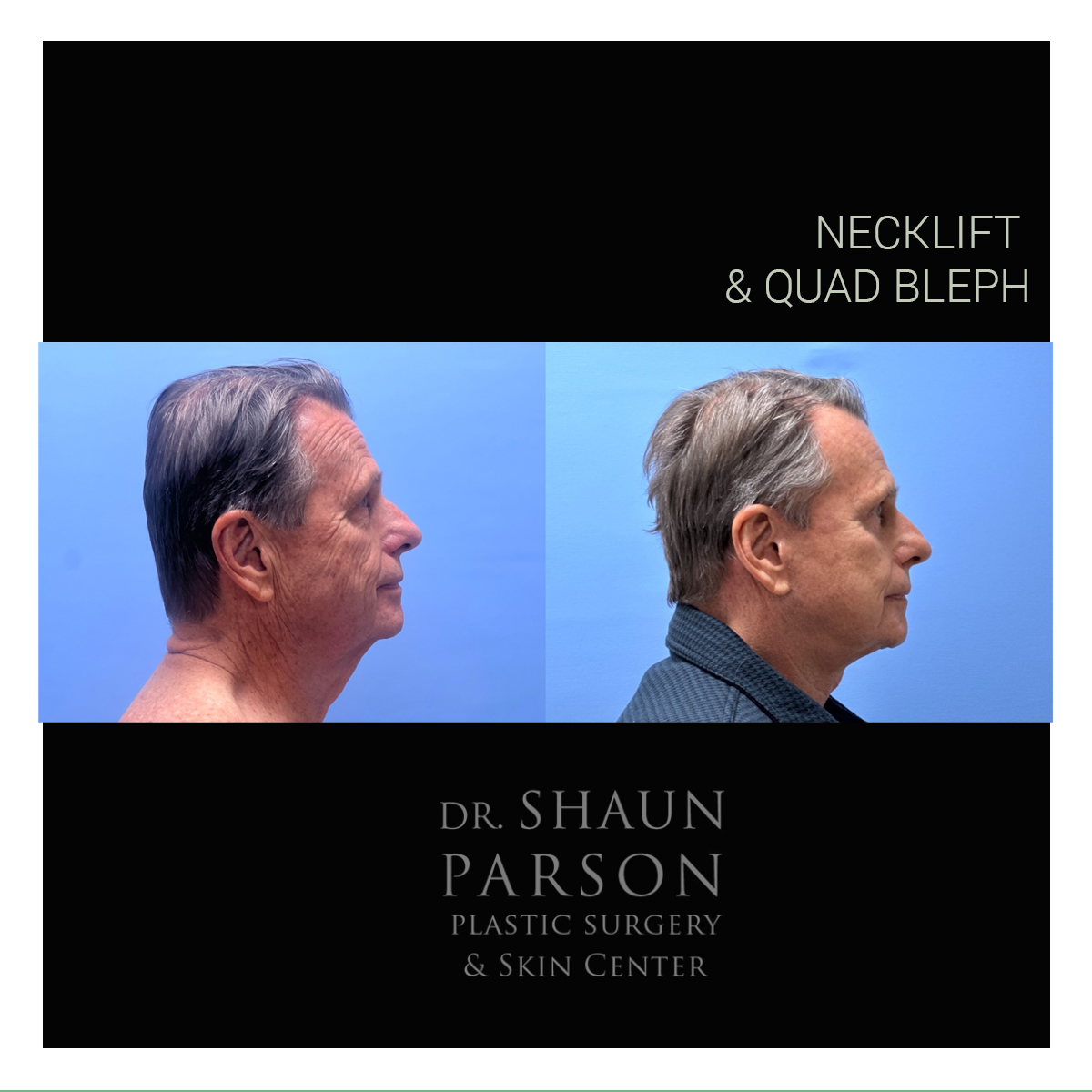 Necklift + Quad Bleph Patient 34 | Dr. Parson Scottsdale